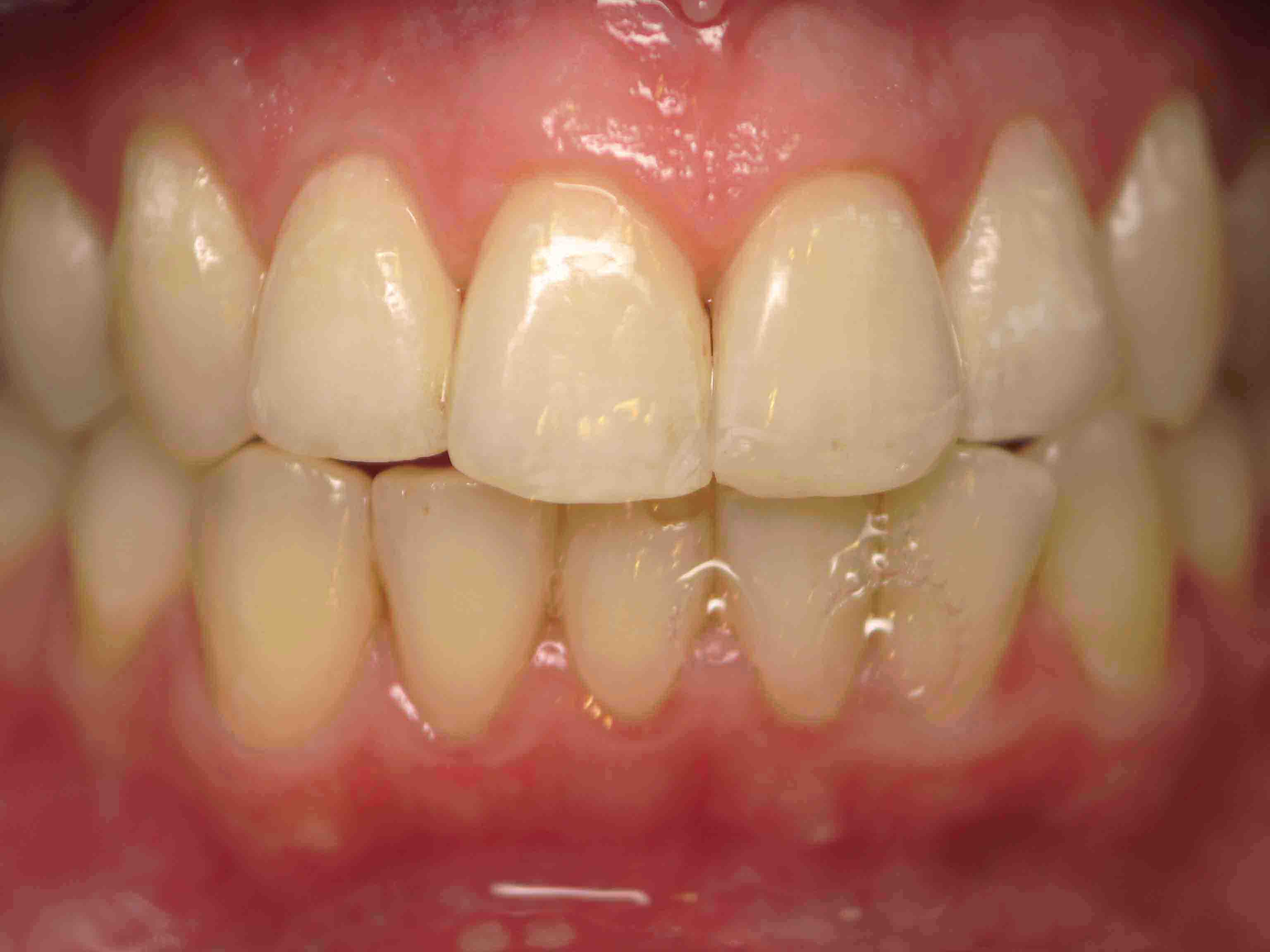 After orthodontic treatment